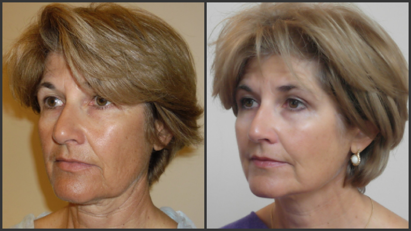 Woman before and after non-surgical facelift
